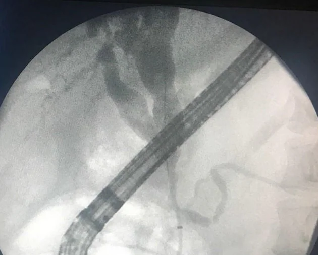 ERCP - BILIARY CYSTIC DILATATION