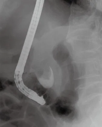 ERCP - LARGE FILLING DEFECT