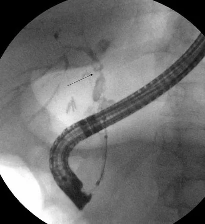 ERCP - SCLEROSING CHOLANGITIS