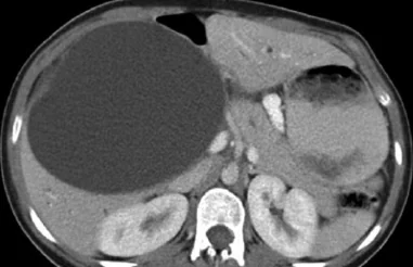 GIANT CHOLEDOCHAL CYST