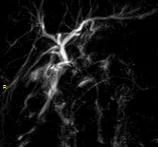 IATROGENIC TRANSECTION COMMON BILE DUCT