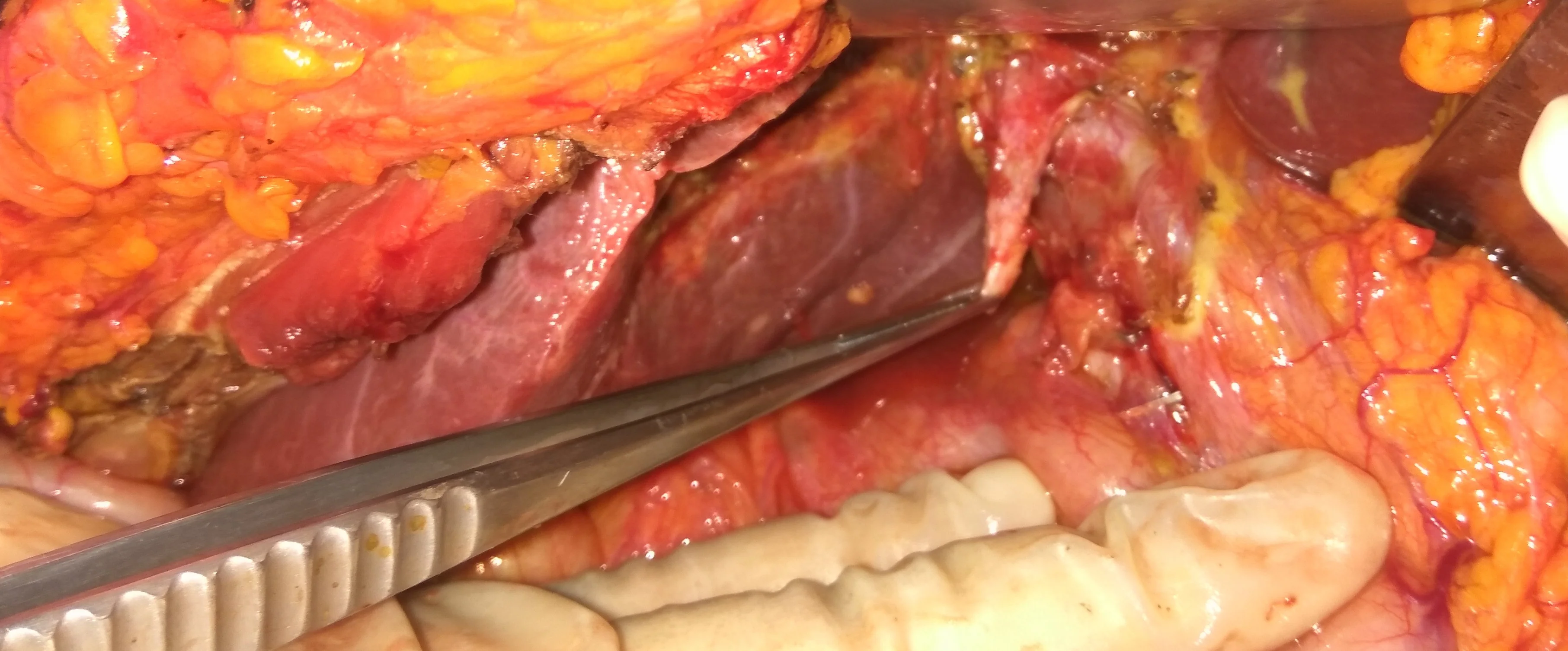 IATROGENIC TRANSECTION COMMON BILE DUCT