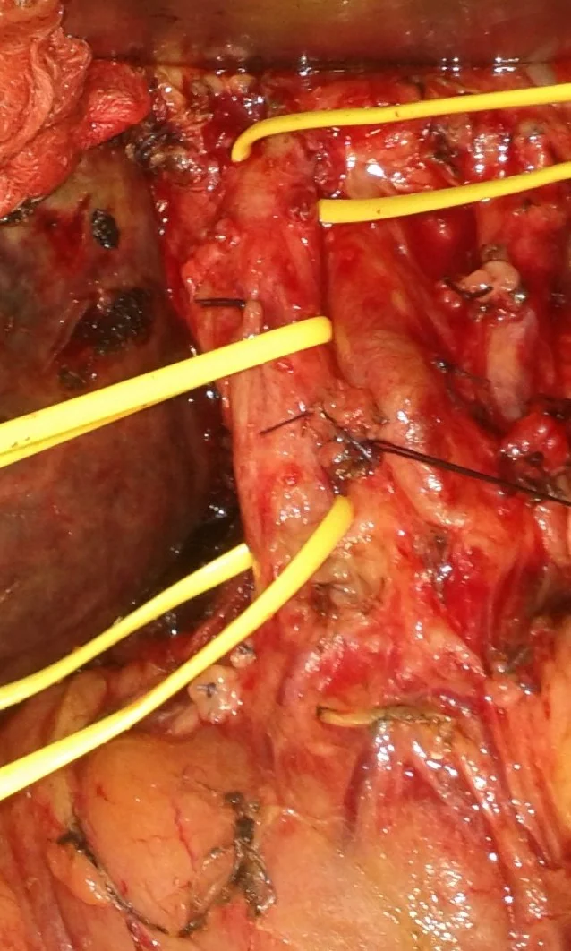 DISSECTION OF THE COMMON BILE DUCT