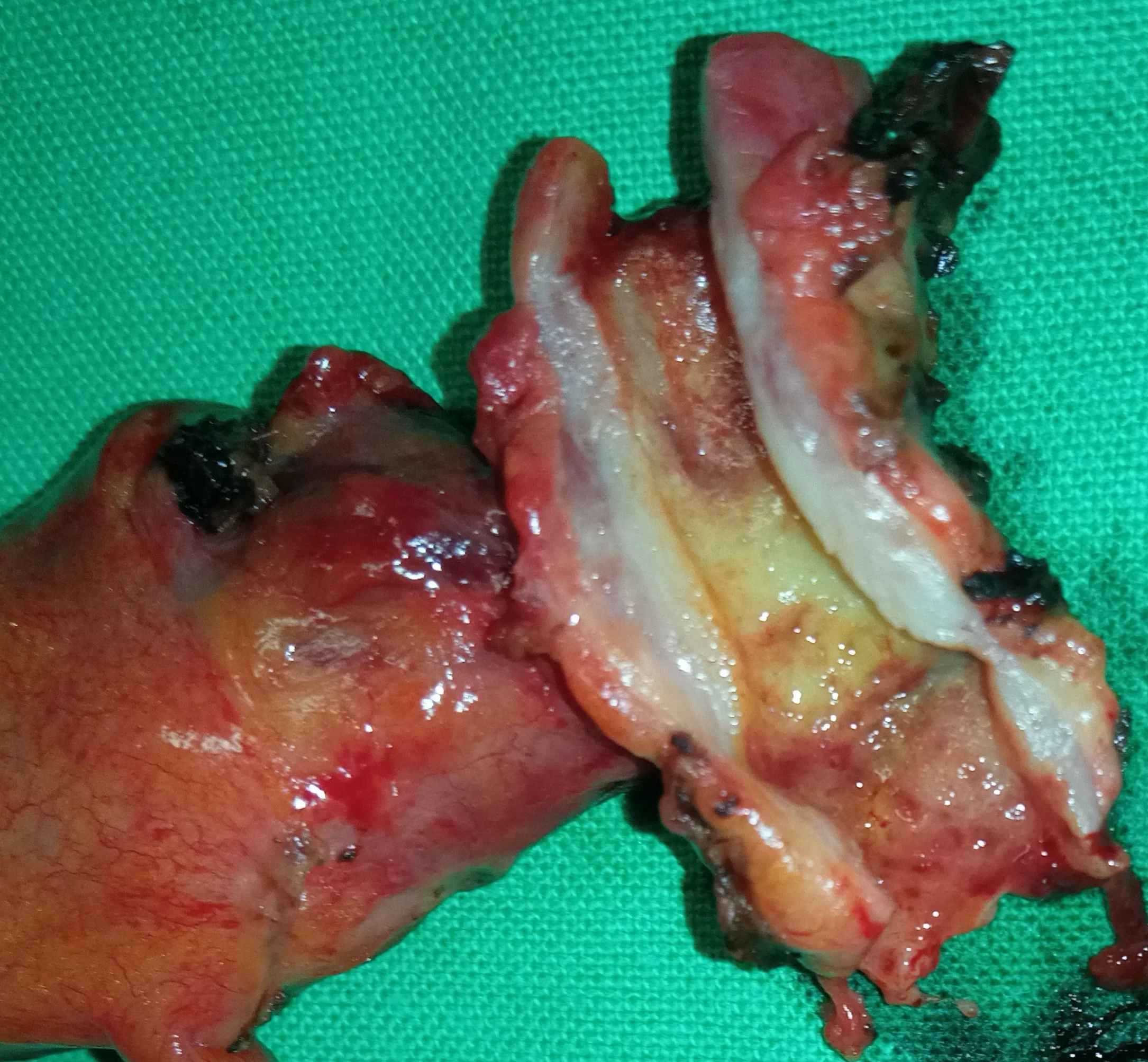 CHOLANGIOCARCINOMA