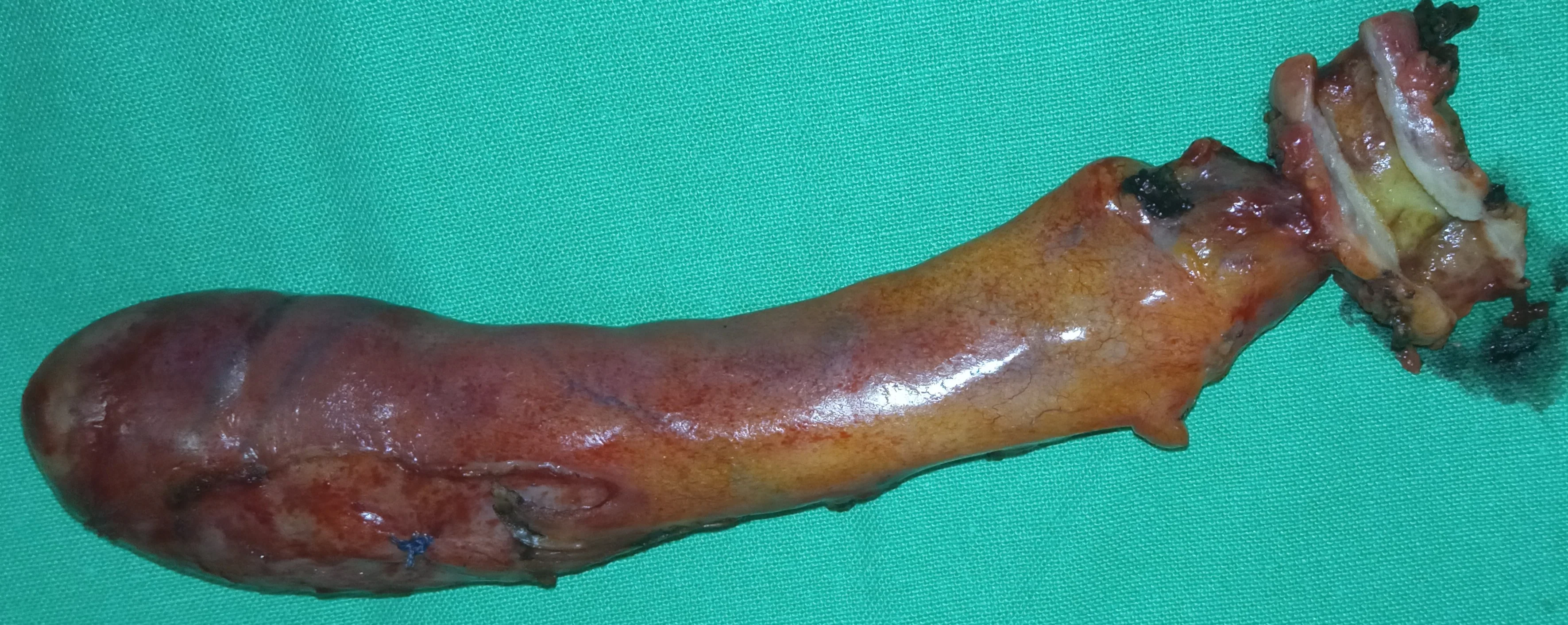 EXCISION OF CHOLANGIOCARCINOMA