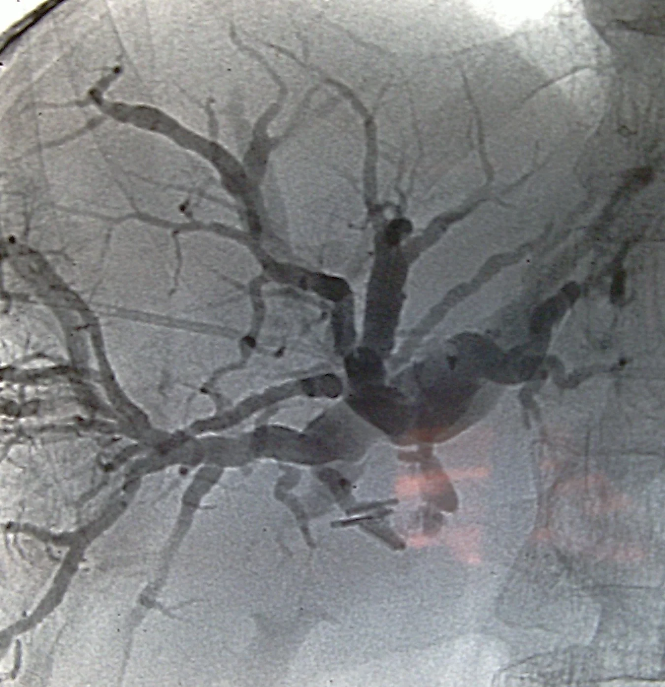 INNOPERABLE CARCINOMA PORTA HEPATIS