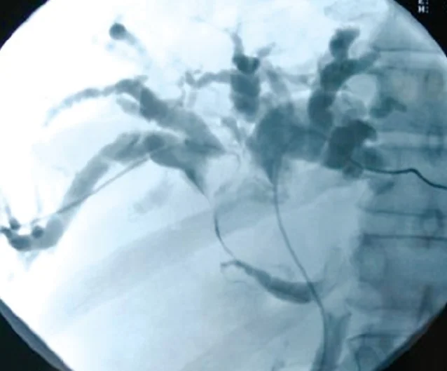 INTRAHEPATIC CHOLANGIOCARCINOMA
