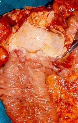 COMMON BILE DUCT CARCINOMA