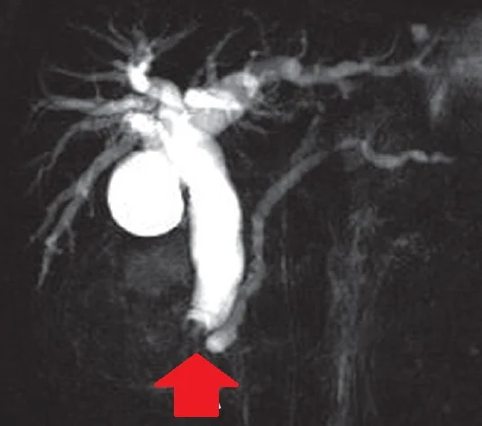 MRCP - AMPULLARY TUMOR