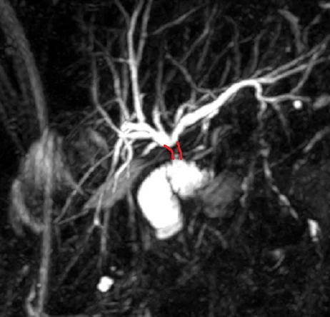 MRCP - BILIOENTERIC ANASTOMOSIS