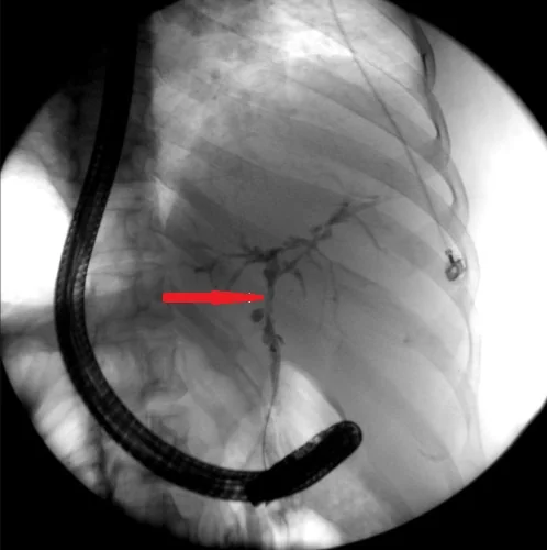 PRIMARY SCLEROSING CHOLANGITIS 