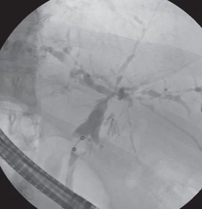 PRIMARY SCLEROSING CHOLANGITIS