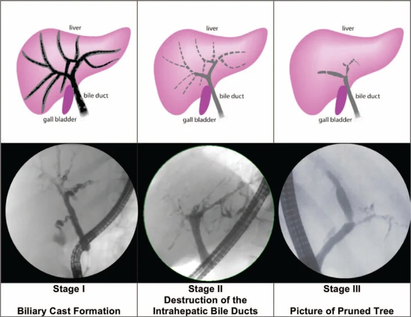 SCLEROSING CHOLANGITIS