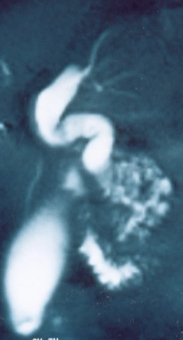 MIRRIZZI'S SYNDROME