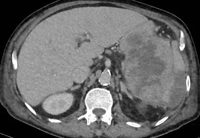 PANCREATIC CARCINOMA