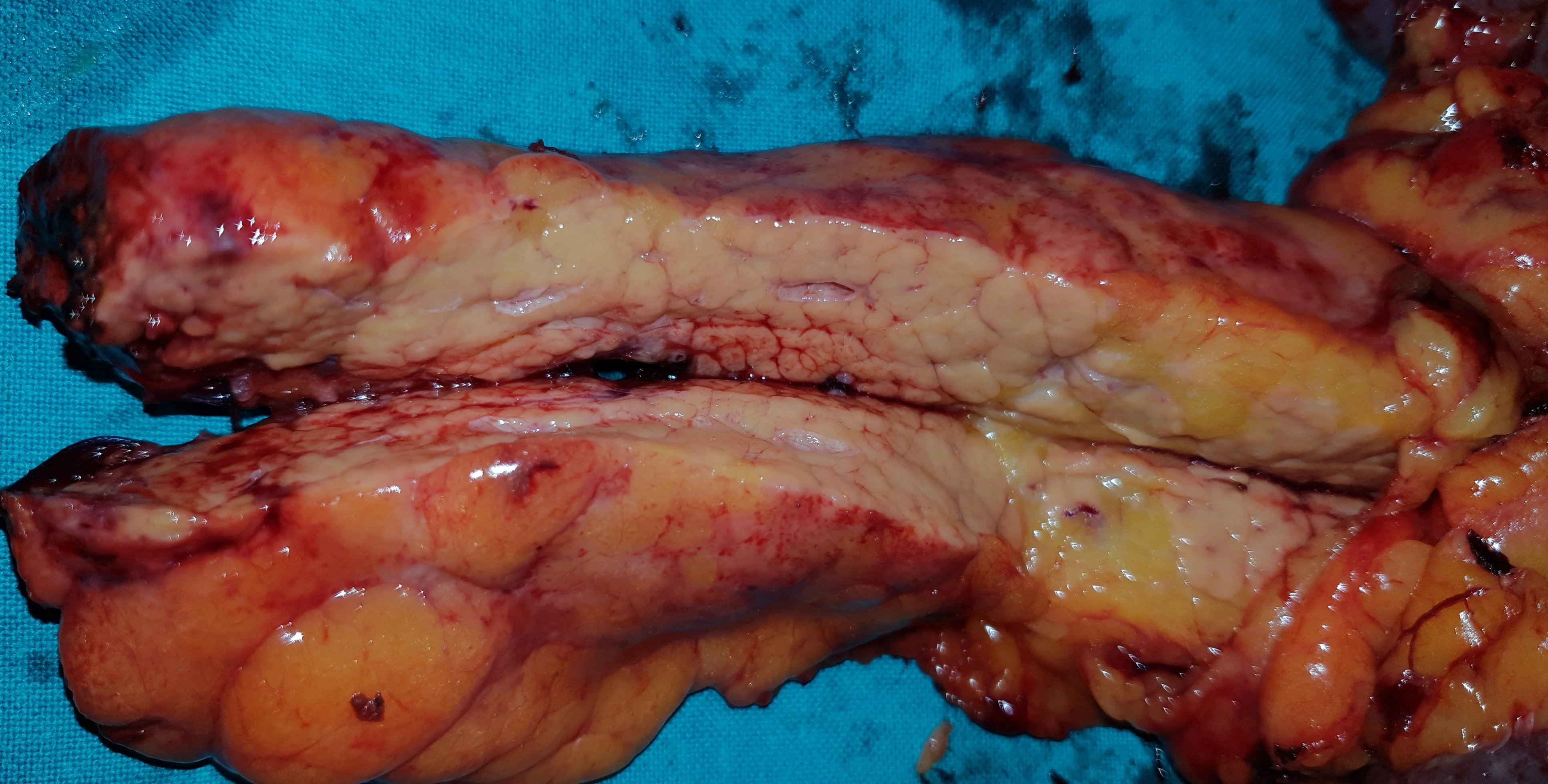 MULTIFOCAL PANCREATIC CARCINOMA