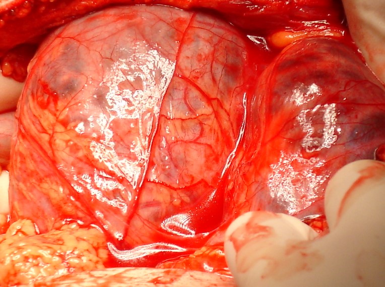 PANCREATIC PSEUDOCYST