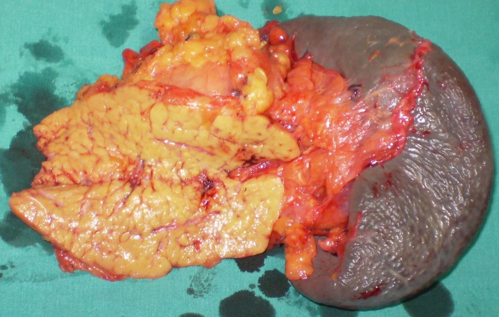 NET TAIL OF PANCREAS