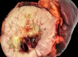 ACINAR CELL TUMOR