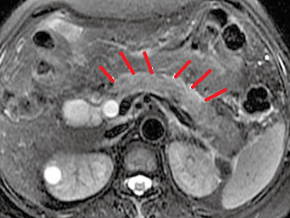 ACUTE PANCREATITIS