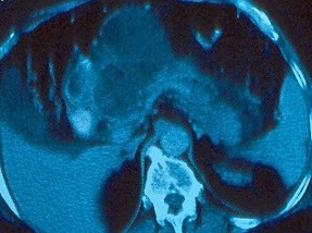 PANCREATIC ABSCESSES