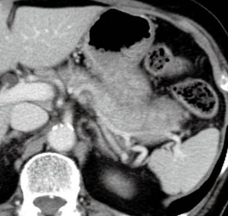 AUTOIMMUNE PANCREATITIS