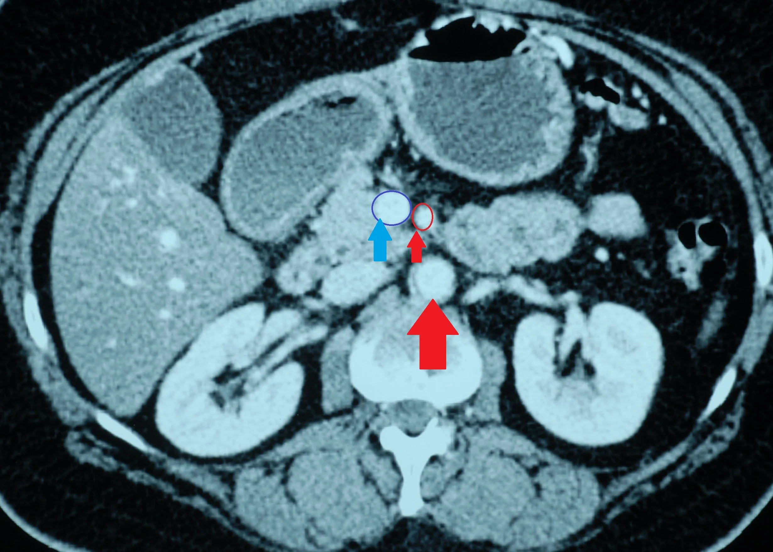 SUPERIOR MESENTERIC VESSELS - AORTA