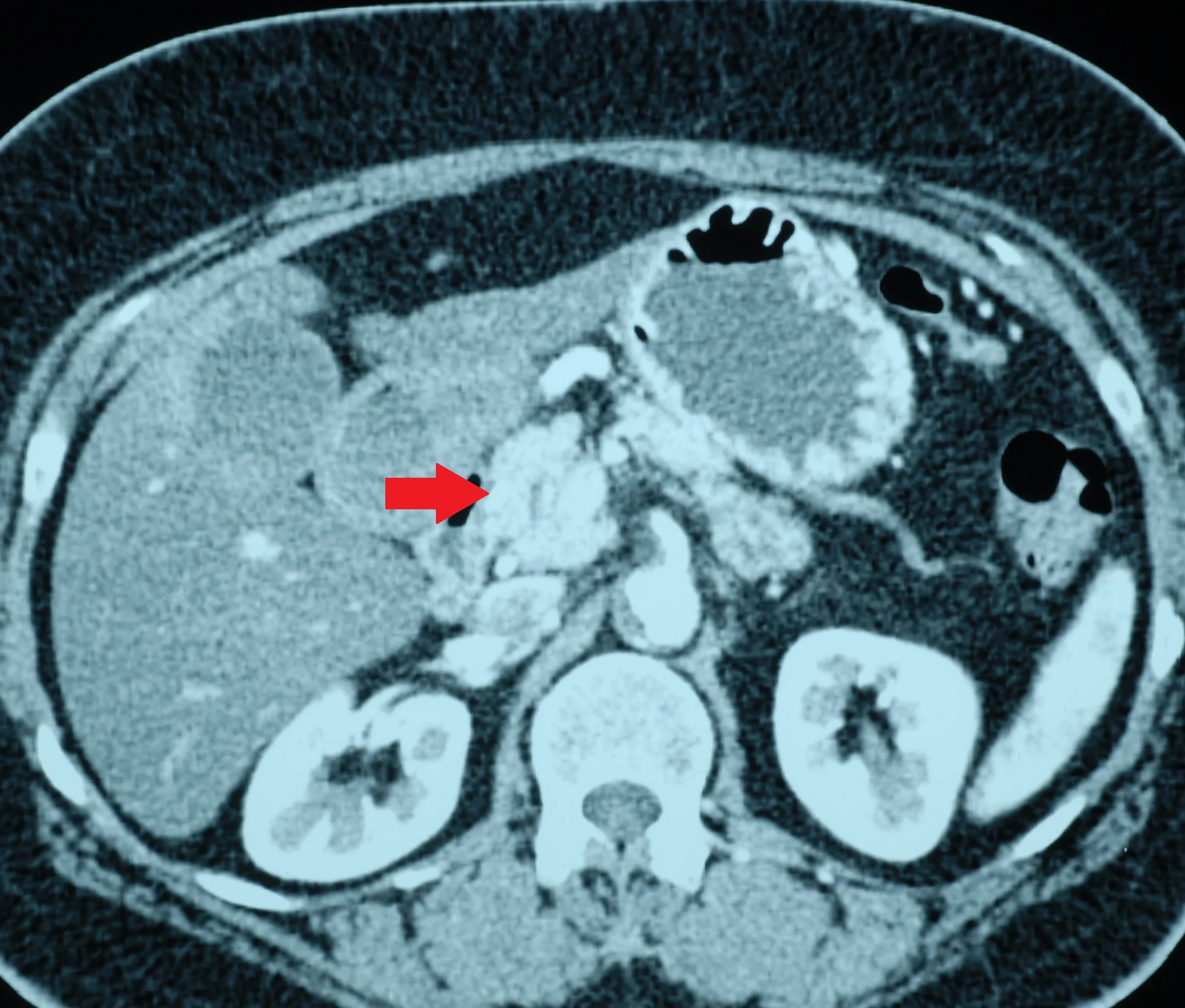 CA HEAD OF PANCREAS