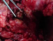 CHRONIC CALCIFIC PANCREATITIS