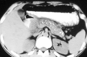 CHRONIC CALCIFIC PANCREATITIS