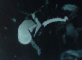CHRONIC CALCIFIC PANCREATITIS