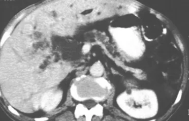 CHRONIC CALCIFIC PANCREATITIS