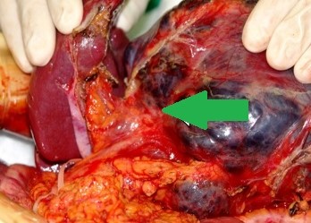 PANCREATIC CYSTIC LYMPHANGIOMA