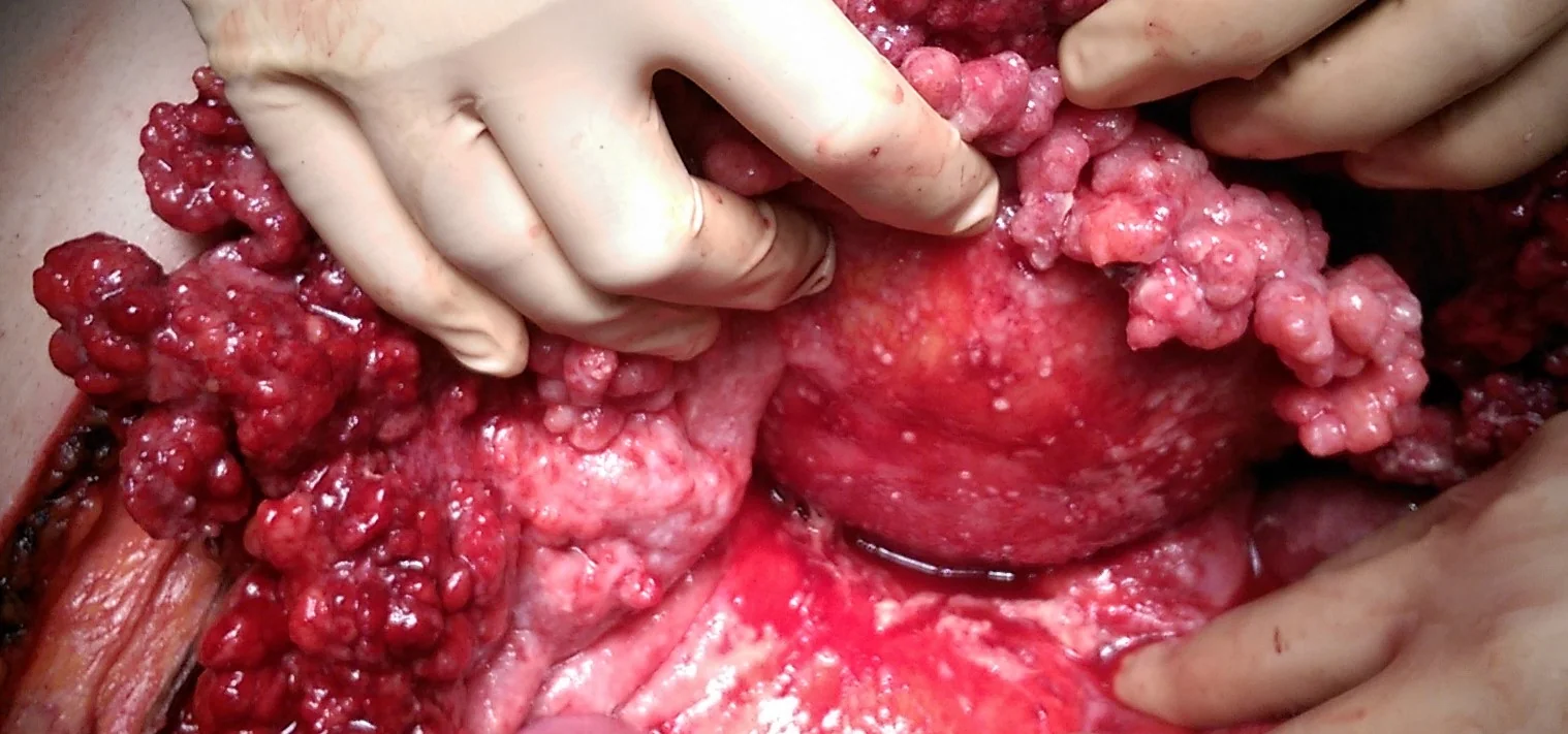 INFILTRATION ROOT OF MESENTERY