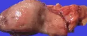 HETEROTOPIC PANCREAS