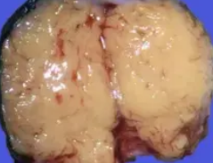 HETEROTOPIC PANCREAS 