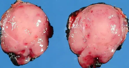 INSULINOMA