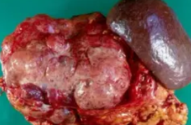 MICROCYSTIC ADENOMA