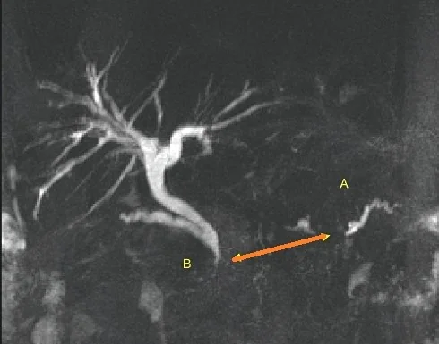 DISCONNECTED PANCREATIC DUCT SYNDROME
