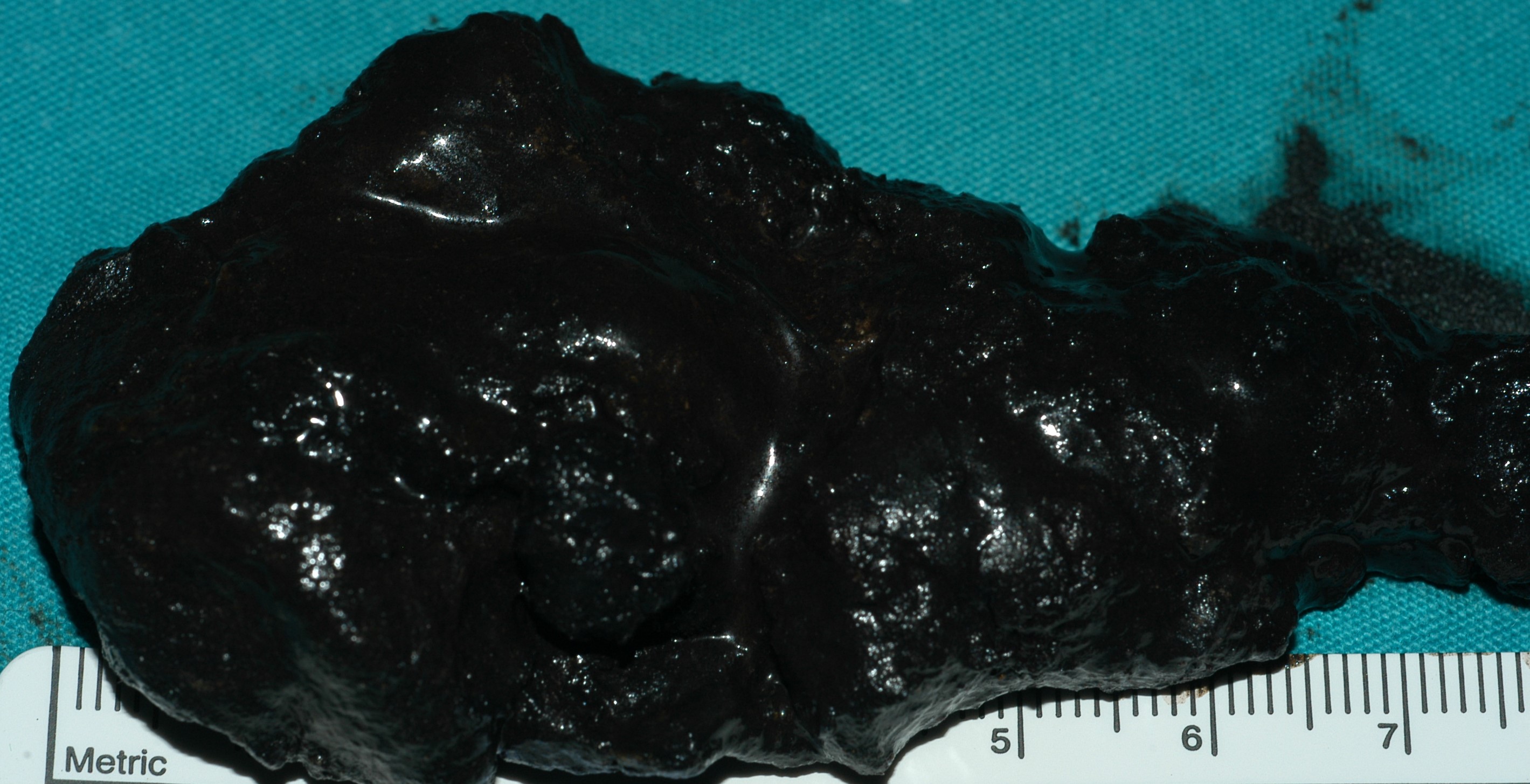 PANCREATITIS - NECROSECTOMY
