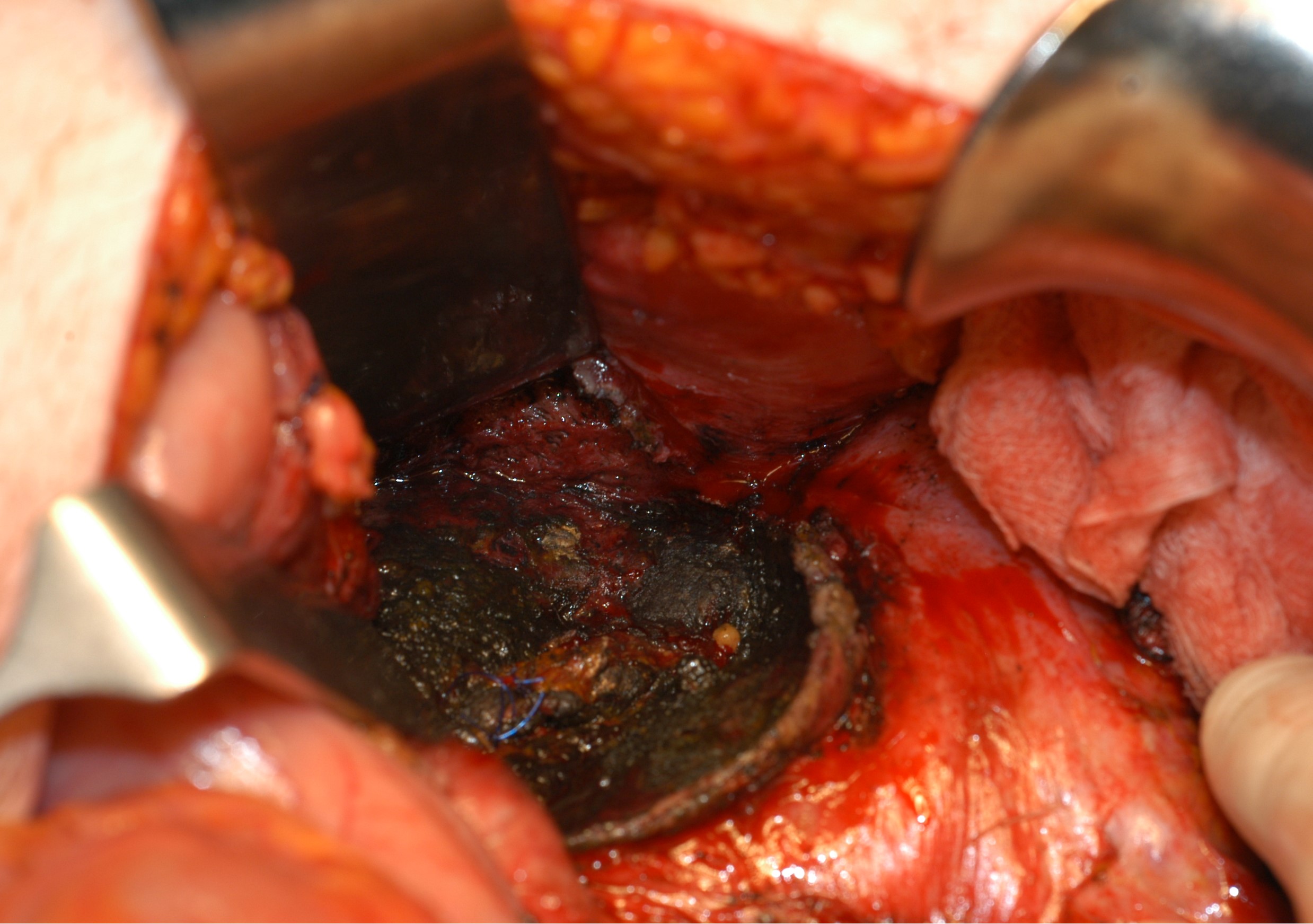 NECROTIC PANCREATITIS