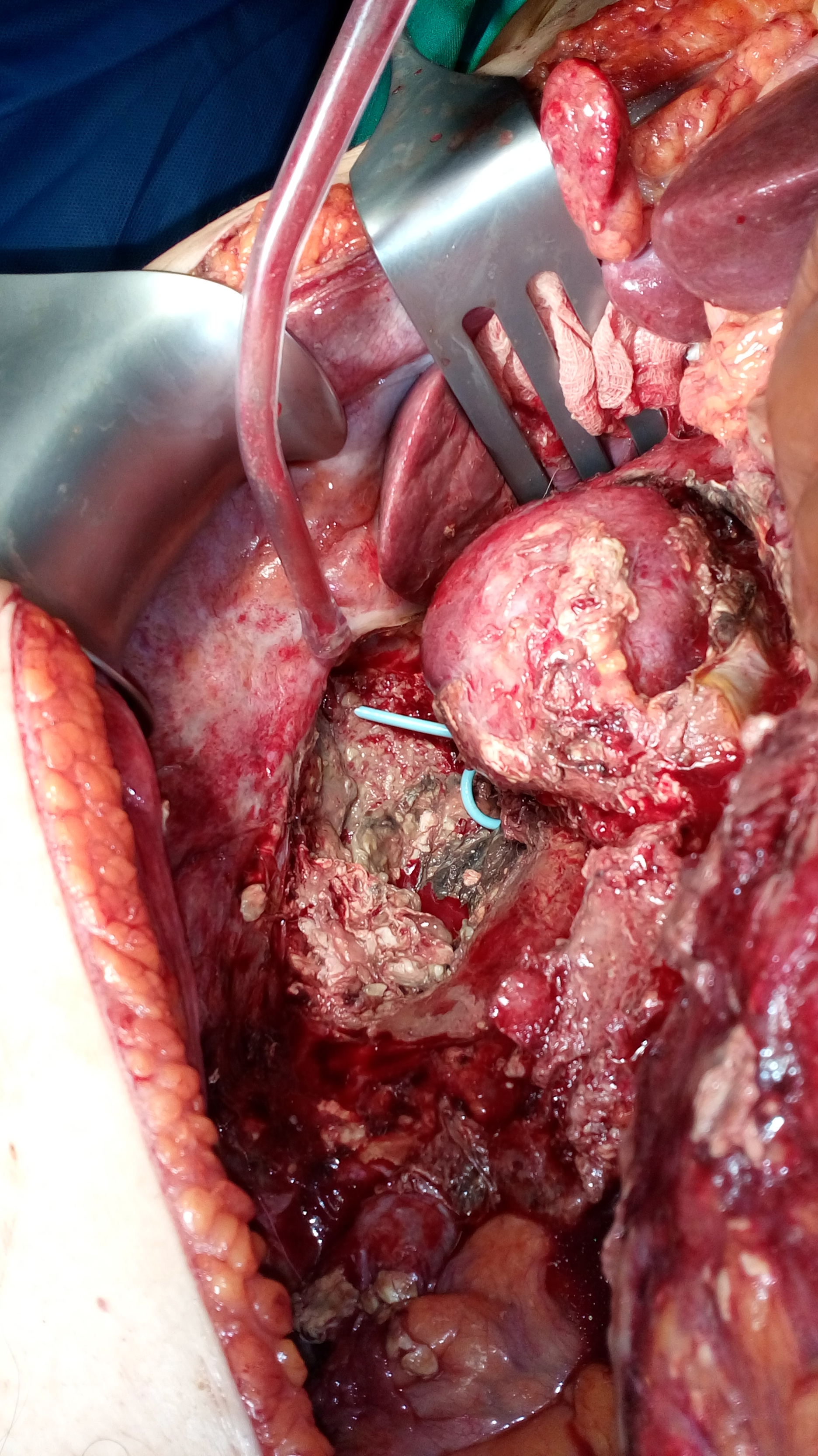 NECROTIC PANCREATITIS