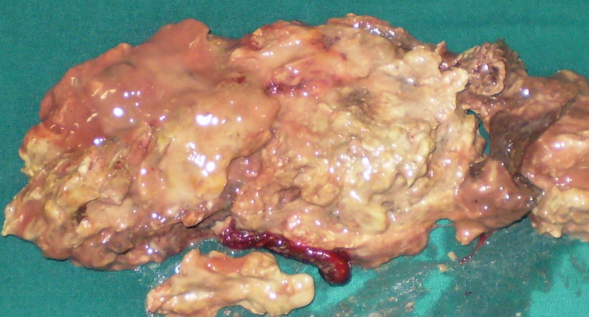 NECROTIC PANCREATITIS 