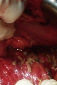 NECROTIZING PANCREATITIS