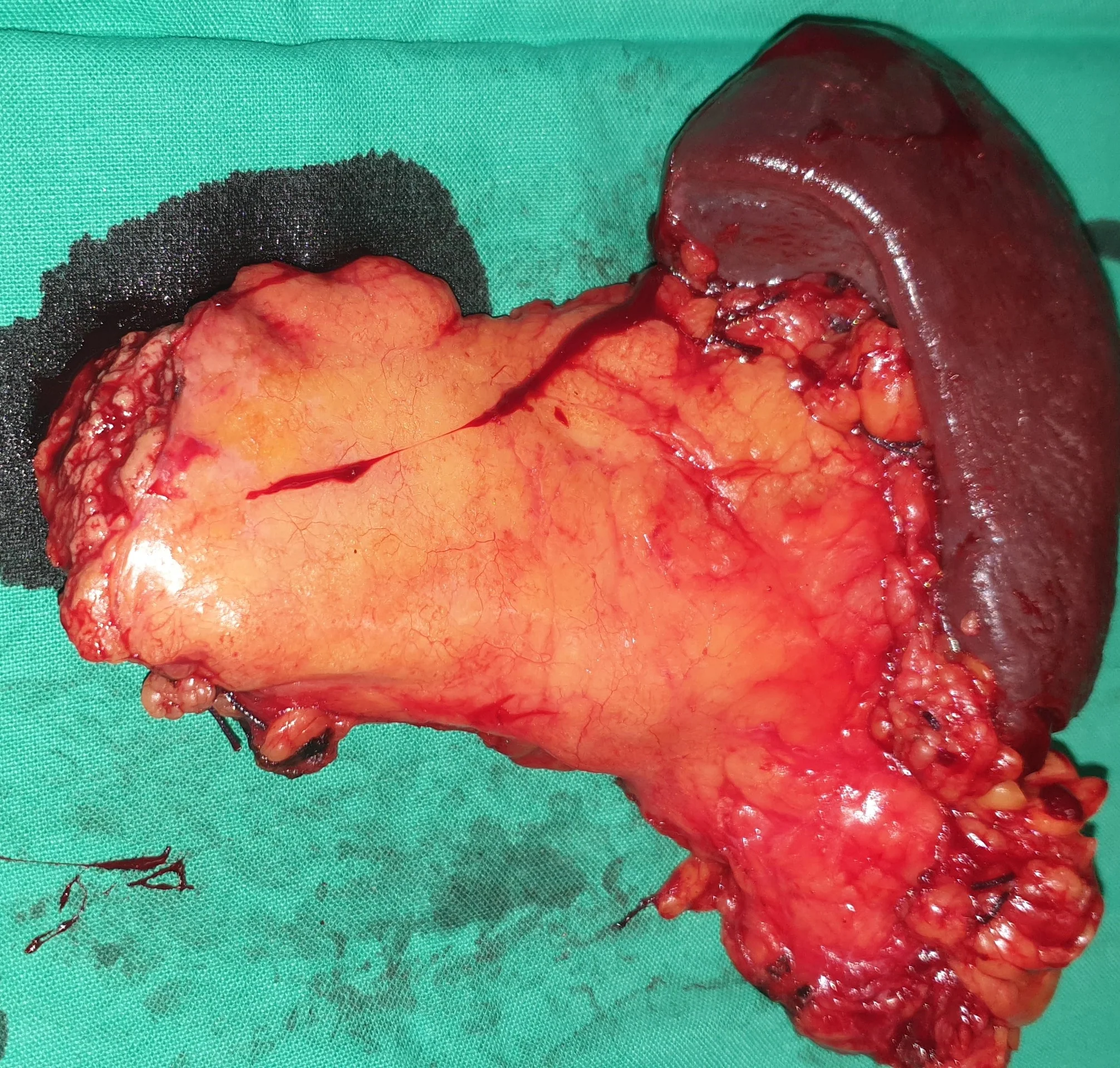 NET - DISTAL PANCREATECTOMY
