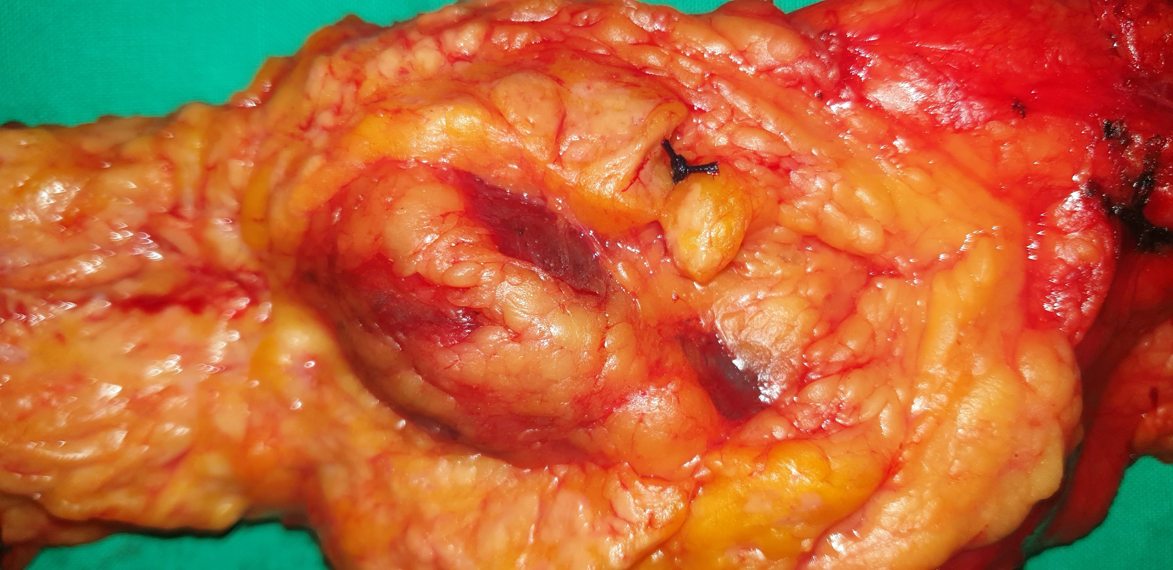 NET - PANCREATIC TAIL