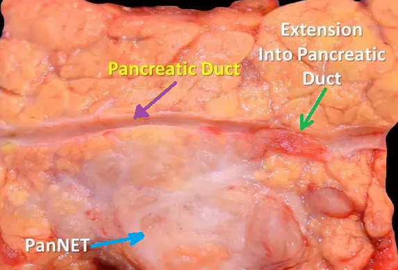 NON FUNCTIONING PANCREATIC NET