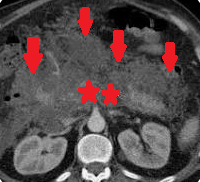 NECROTIZING PANCREATITIS