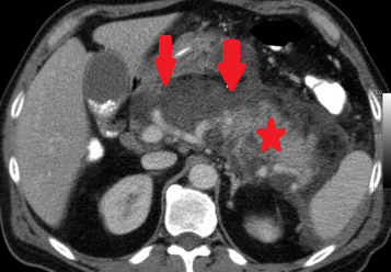 NECROTIZING PANCREATITIS