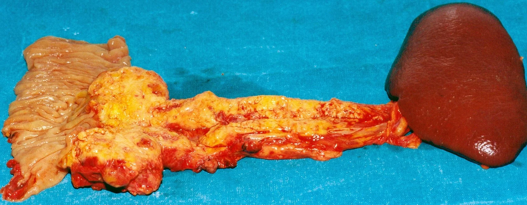 TOTAL PANCREATECTOMY